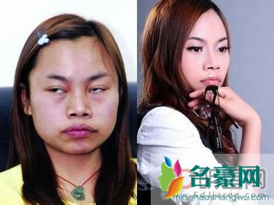 凤姐80万整容后照片对比 花钱就会有收获是比以前漂亮了