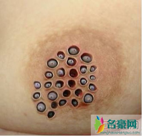 莲蓬乳是怎么形成的很恶心 只想撕碎或把里面的东西挑出来的强迫症