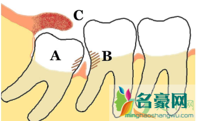 智齿横着长拔牙有风险吗1