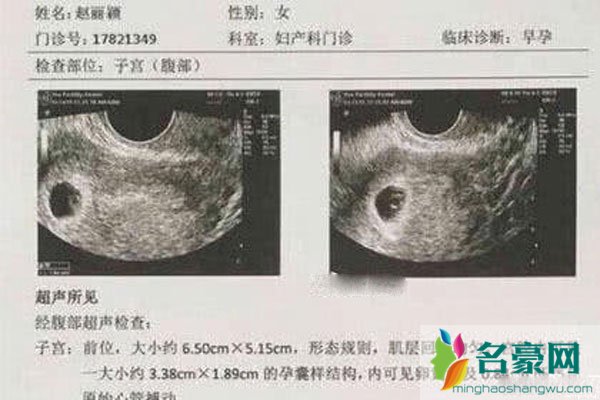 赵丽颖怀孕大肚照曝光 大把明星怀孕都否认等承认都快生了