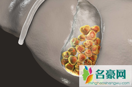 胆囊结石手术必须取胆吗2