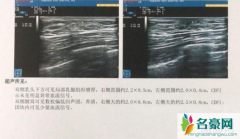 26岁小伙健身3个月乳房发育 小伙慌了崩溃大喊我还