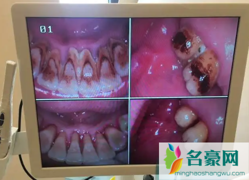 牙结石0度到3度的图2