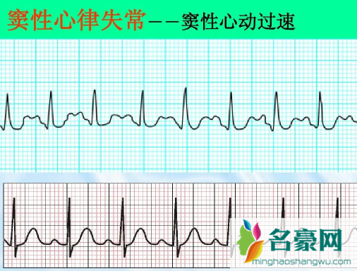 窦性心律不齐是心脏病早期吗3